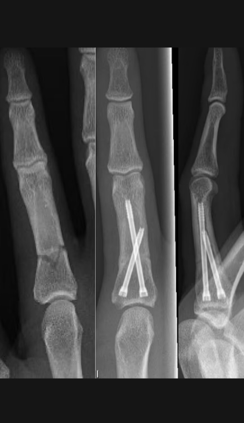 Frakturen der Finger und Luxation von Fingergelenken