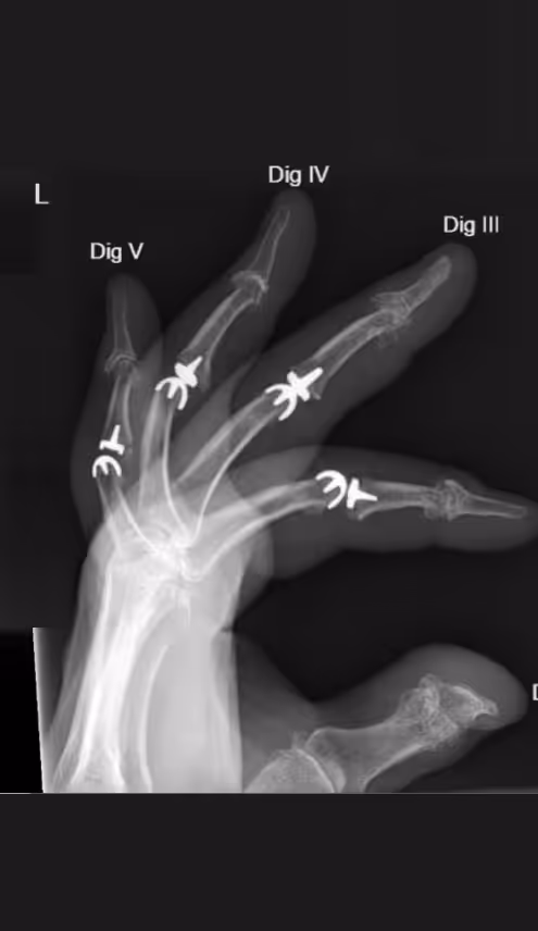 Arthrose der Fingergelenke