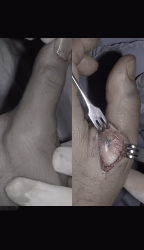 Muskel - und Bandverletzungen in der Handchirurgie